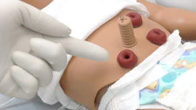 s107-ostomy